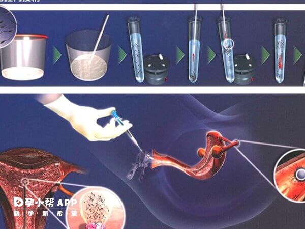 人工授精为什么容易胎停