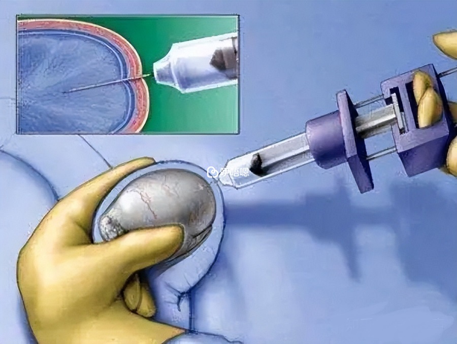 输精管缺失的患者可以穿刺取精