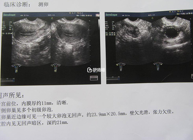 卵子质量改善方法