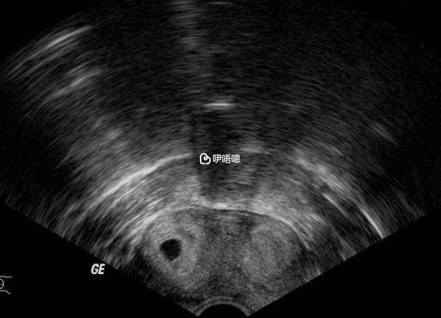 双角子宫超声图