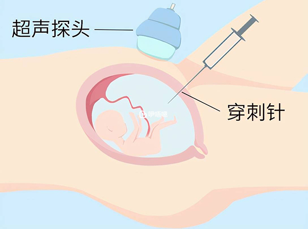 进一步检查可选择无创DNA或者羊水穿刺