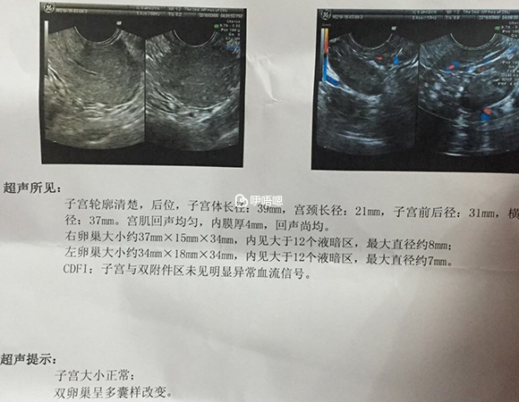 有卵巢水肿千万不要急功近利当月移植