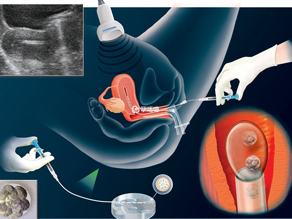 人工授精从精神还是身体上比试管少受苦