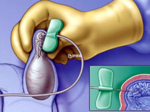 梗阻性无精子症患者需要做睾丸穿刺术