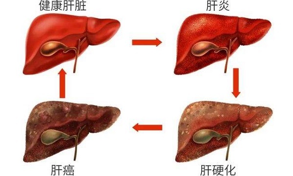 肝功能异常是抑那通最大副作用之一