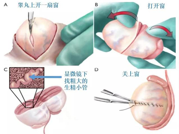 显微取精术