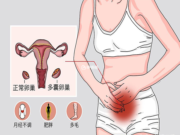 多囊可能导致无法受孕