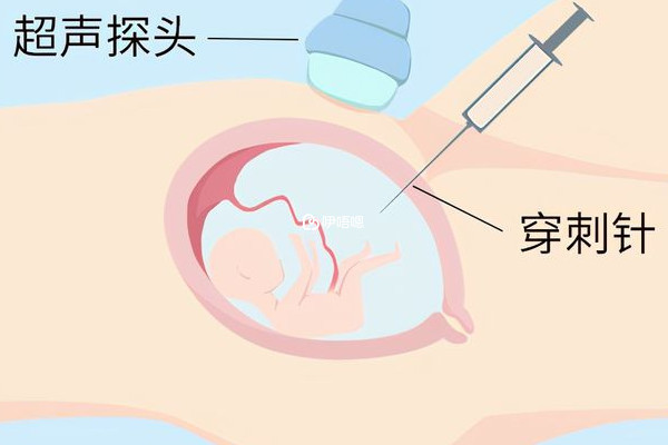 100个羊水穿刺约有一个不通过